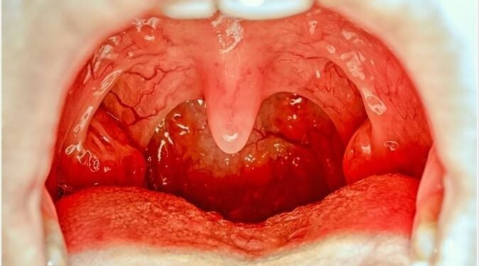 Can Tonsils Grow Back After Being Removed? – Tymoff – An In-Depth Analysis