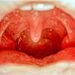Can Tonsils Grow Back After Being Removed? – Tymoff – An In-Depth Analysis