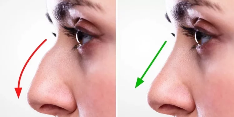 rhinoplasty