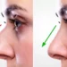 rhinoplasty